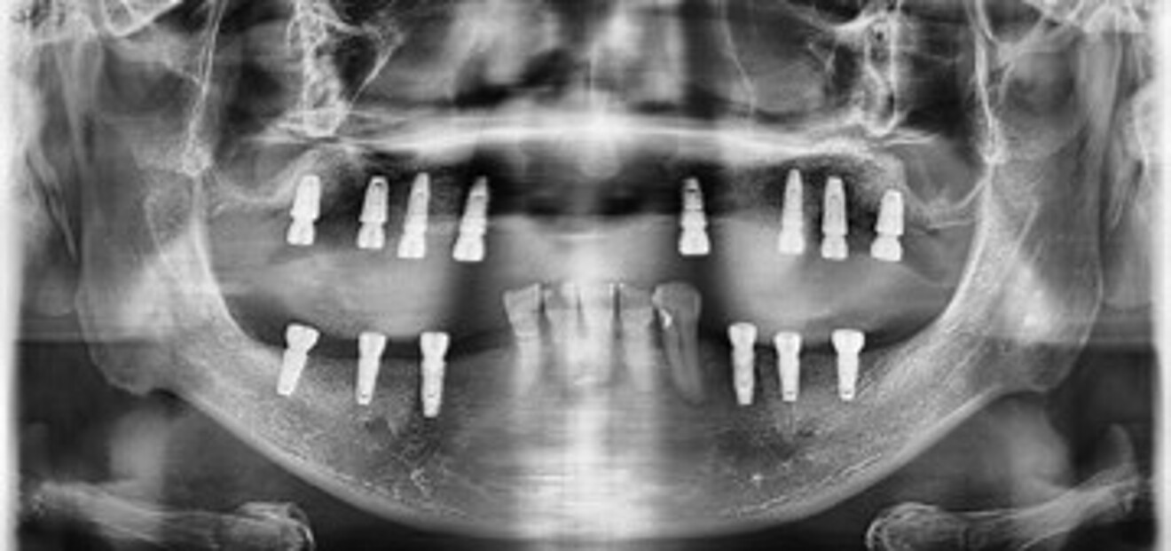  Figs. 4c: Post-treatment panoramic radiographs.