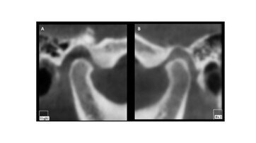 Fig. 4_CBCT delle articolazioni Temporomandibolari in occlusione abituale. 