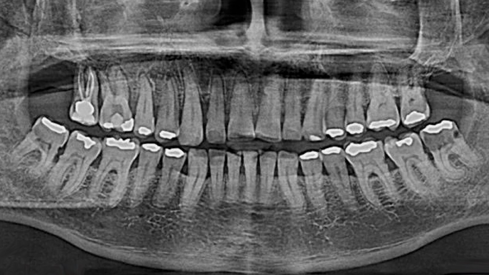 Complicaciones maxilofaciales en un paciente con cáncer de próstata