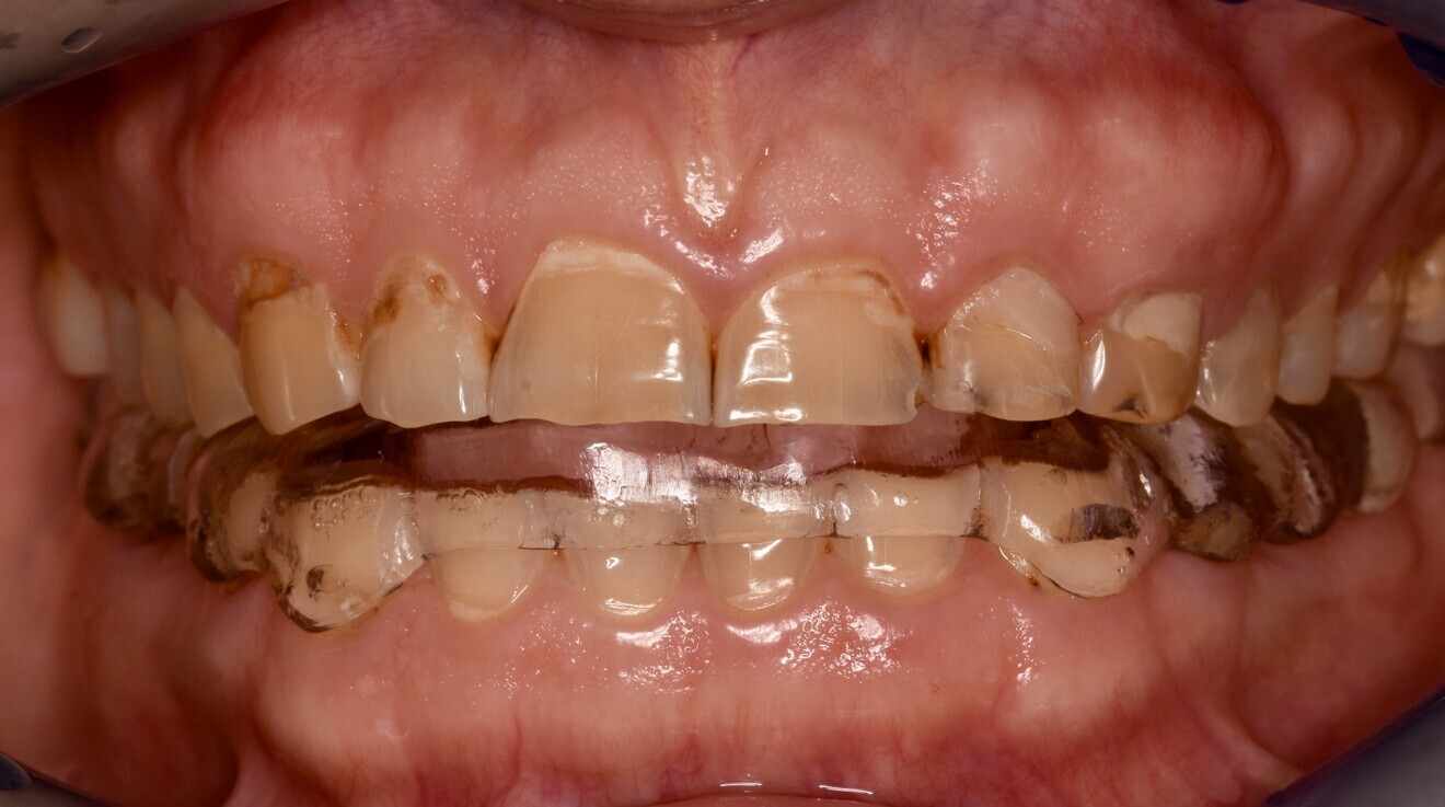 Fig. 4b: Mandibular splint in situ.