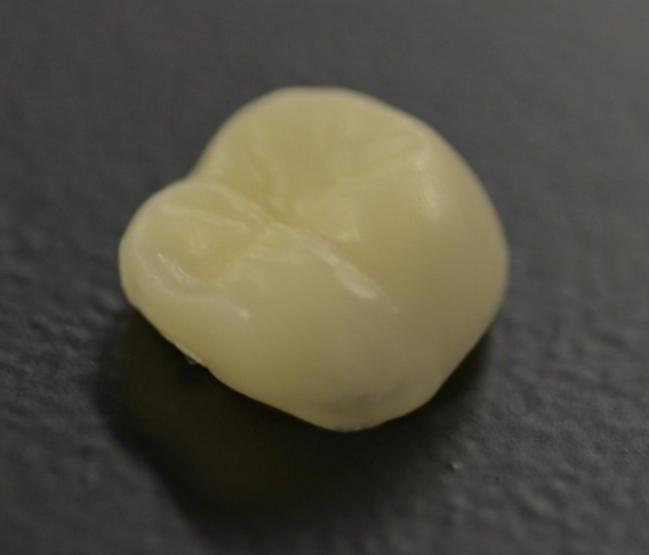 Fig. 12a: Completed 3D-printed provisional crown.