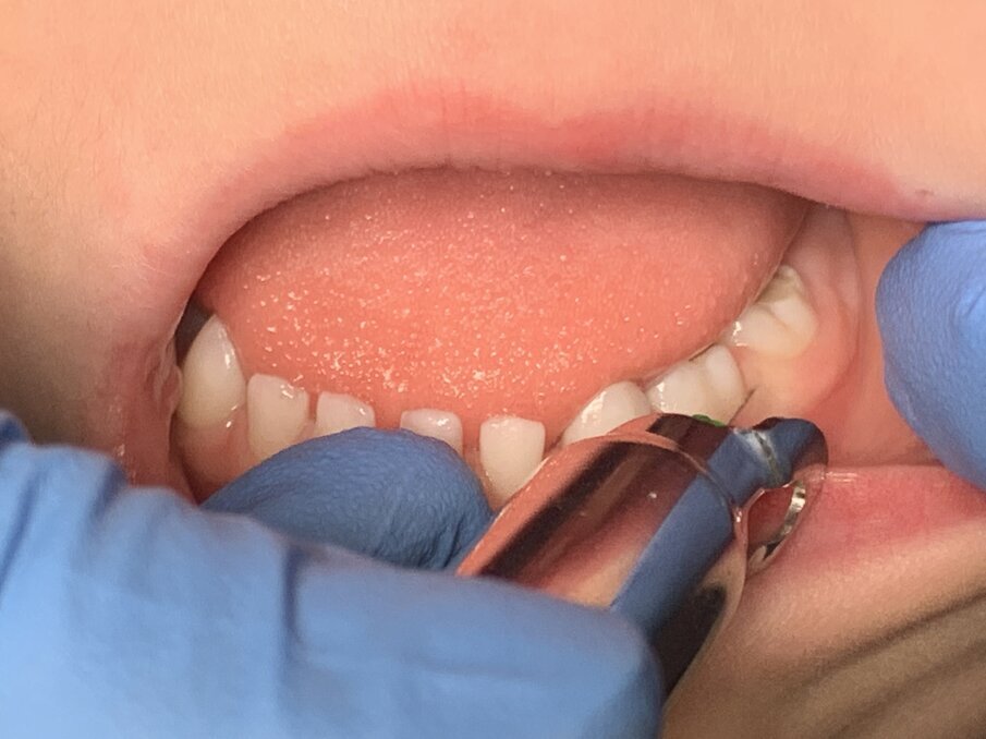 Afbeelding 2. Eerste infiltratie in de papil met de naald van de Quicksleeper. 