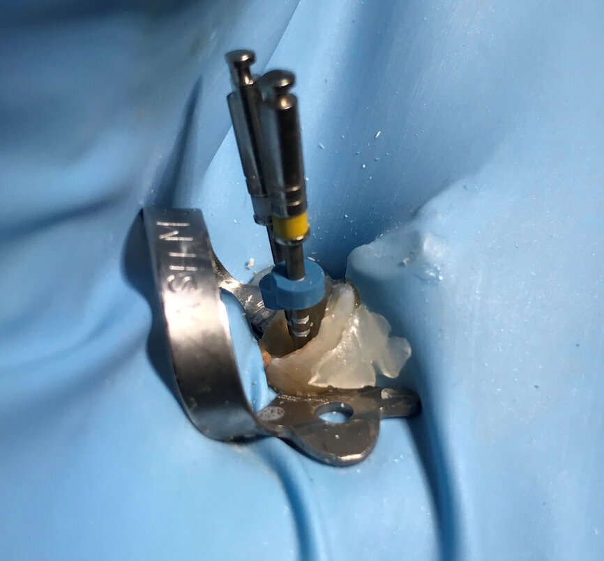 Fig. 5: VDW.ROTATE 15.04 and 20.05 files inserted into the root canals for the working length radiograph.