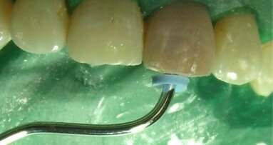 Single-visit apexification withMTA following ozone disinfection