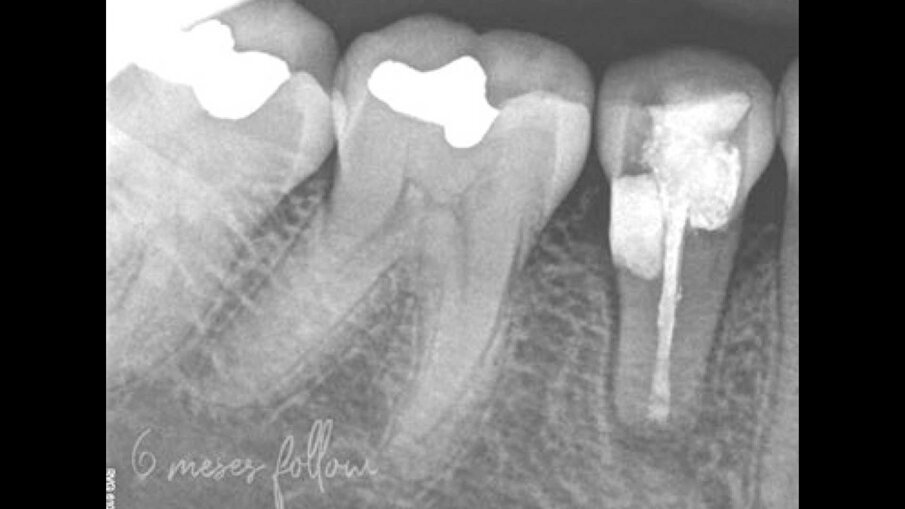 Fig. 7 - La radiografia periapicale a sei mesi mostrava una guarigione quasi completa e nessun segno di patologia apicale.