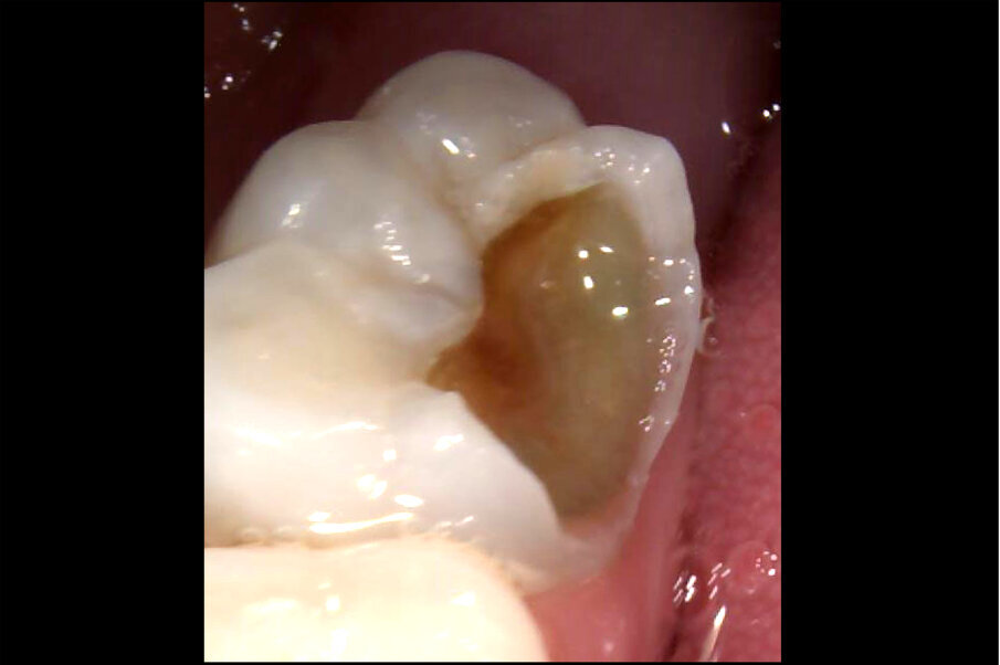 Afbeelding 1. Casus 1: 18-12-19. Kiespijn dreigt. ZDF aanbrengen veroorzaakte minutenlang pijn.