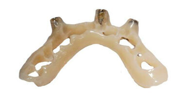 Il posizionatore guidato: modifiche della tecnica attuale  nella protesi implantare immediata