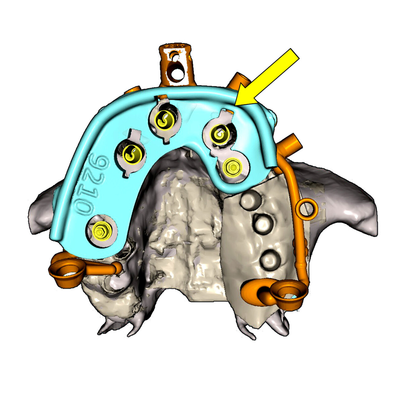 Fig. 11a: Occlusal view of the bone reduction and timing jig seated on the base frame over the MUAs, showing recessed markers indicating implant rotational orientation.