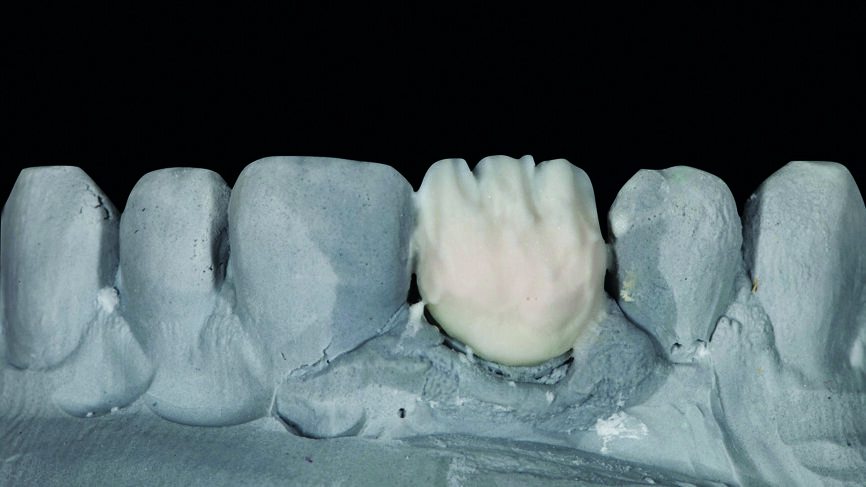 Fig. 8 : Application de la formule correspondant à la dentine du tiers coronaire. 