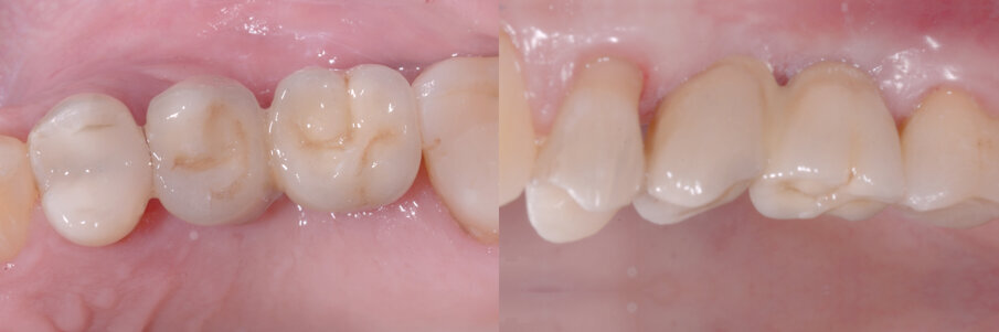 Fig. 9 - La protesi definitiva. L’otturazione in amalgama che interessava l’elemento 2.4 è stata sostituita con una in resina composita.
