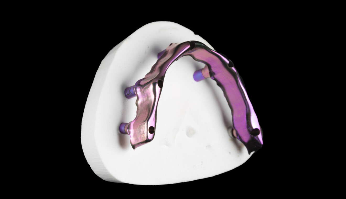Fig. 5: Primary titanium structure.