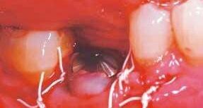 Implantacja natychmiastowa implantu NanoTite™ PREVAIL® z jednoczesnym przeszczepem kostnym