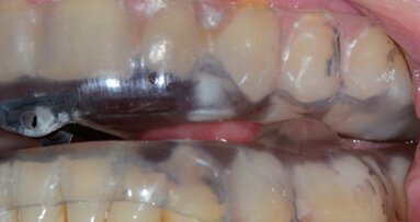 I disturbi del sonno (OSAS) provocano vittime: meglio controllare l’attitudine alla guida di chi ne è affetto