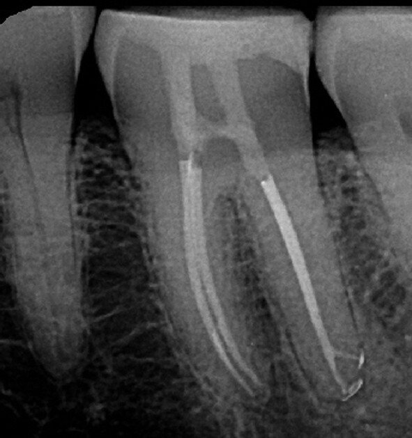 Fig. 7 : Molaire inférieure présentant une calcification presque totale de la cavité pulpaire avant le traitement canalaire, accompli au travers de deux orifices d’accès très précis, laissant entre eux un isthme d’une hauteur de 0,75 mm dans la cavité pulpaire. À noter les résultats finaux du traitement dans les tiers apicaux de chaque canal. (Photo : fournie par le Dr N. Pushpak) 