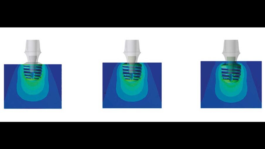 Fig. 12_Von Mises stress per il posizionamento dell’impianto: sopracrestale, crestale e subcrestale.