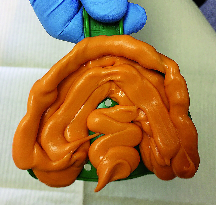 Fig. 7: Achieving full arch impressions with Panasil from Kettenbach.