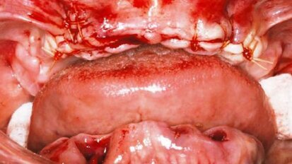 Zaopatrzenie implantologiczne i natychmiastowa odbudowa tymczasowa bezzębnych wyrostków – prezentacja przypadku