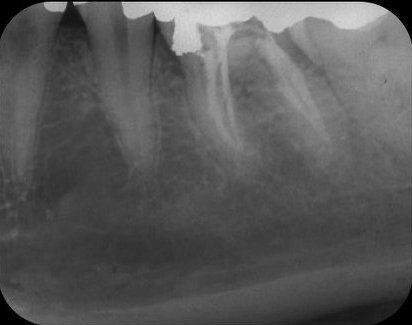 Afb. 3: Kanaalvulling aanbracht en perforatie afgesloten met amalgaam