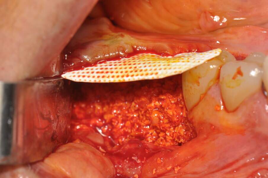 Figg. 5, 6_Si effettua la perforazione del letto osseo ricevente, il fissaggio linguale della membrana Cytoplast tireinforced ed una miscela 1:1 di osso autologo ed eterologo.