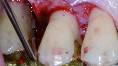 Regeneration in der Parodontaltherapie