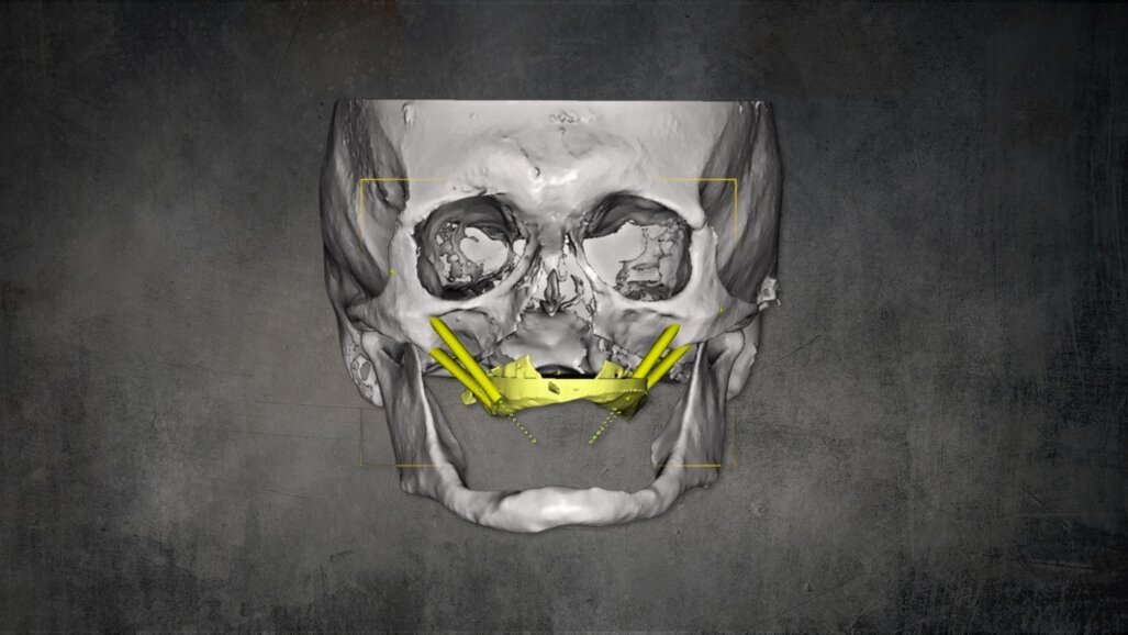 Precise implantation using zygomatic implants with Le Fort I osteotomy