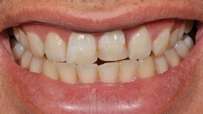 Trattamento biomimetico grazie a una scala colori intelligente modificabile in un caso post-trauma