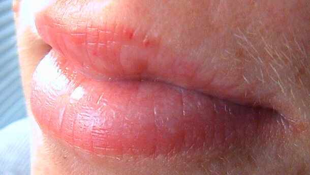 Il Botulino in Italia, un mercato in crescita: +18% dove il paziente tipo è donna tra i 35 ed 55 anni