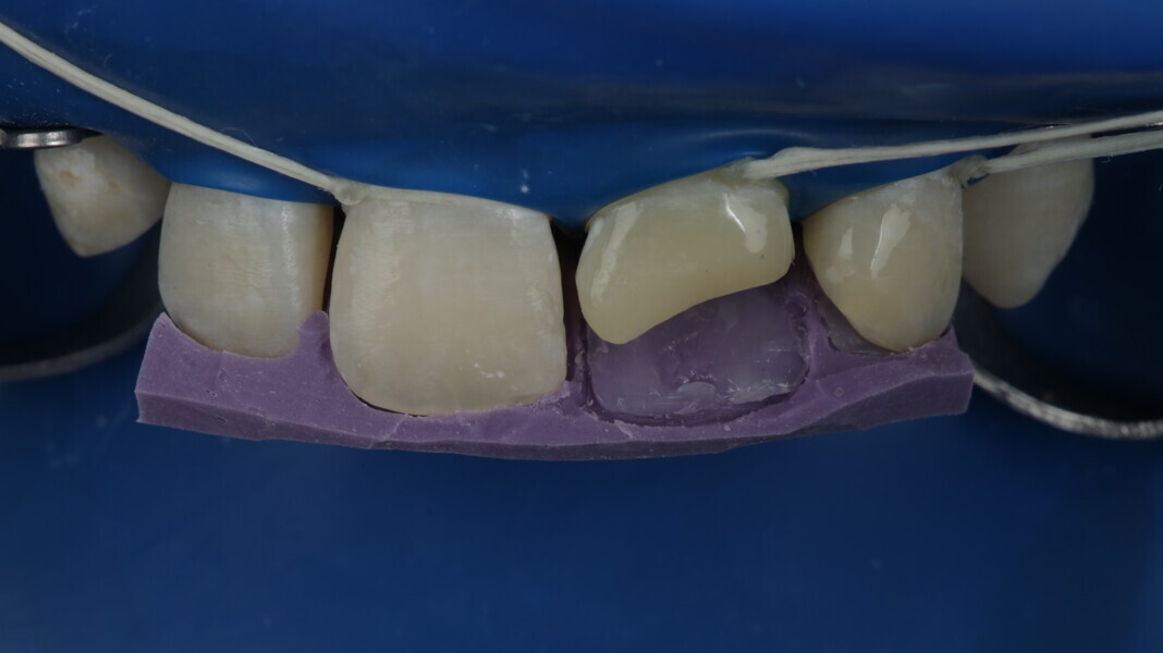 Fig 16: Clear translucent shade was used to build the palatal surface.