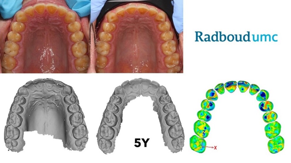 Figuur 2 Monitoring met digitale scans. Subtractie van beide scans geeft de evolutie van de slijtage aan. Groen vertoont geen relevante verschillen, en blauwe gebieden geven de slijtageplekken aan.