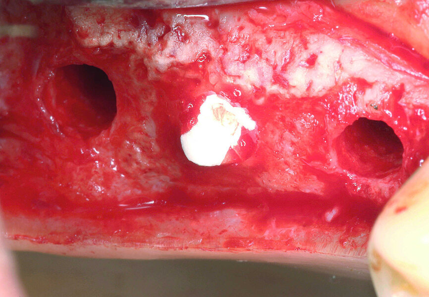 Figs. 10 et 11 : Application d’une membrane de collagène au-dessous de la membrane de Schneider