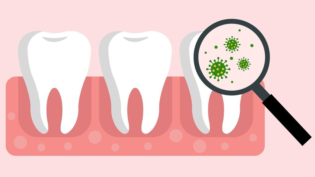 Eisenmangelanämie: Therapie findet Anwendung in Zahnmedizin
