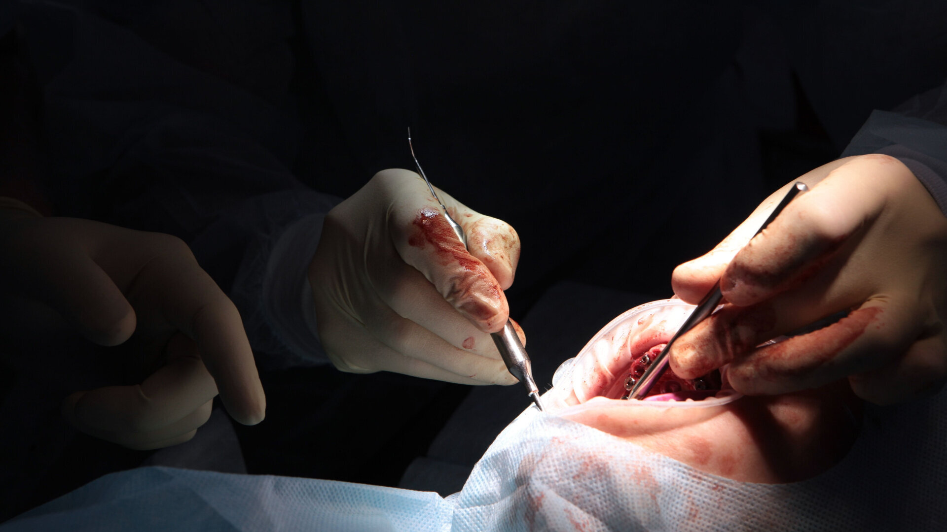 Clinical success in guided full-arch rehabilitation using Smilecloud