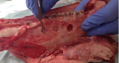 Podśluzówkowa i śródkostna lokalizacja metalowych ciał obcych metodą rezonansu