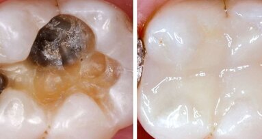 Seitenzahnfüllungen: Aktuelle Trends für Adhäsive und Bulkfill-Technik