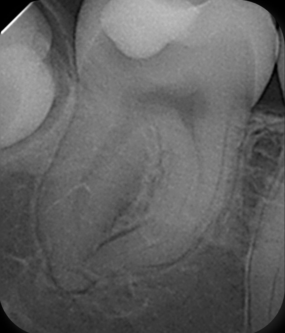 Fig. 1: Pre-op radiograph of the mandibular right second molar showing deep caries beneath the existing restoration and a complex, curved root canal anatomy.