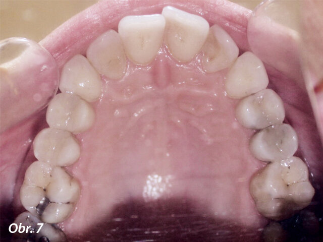 Kazuistika: Lingvální aparát