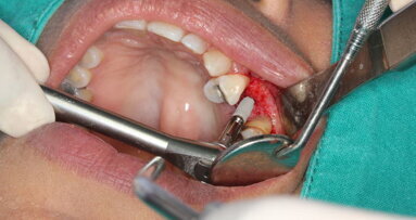 Many Saudi dentists not qualified to perform implant procedures