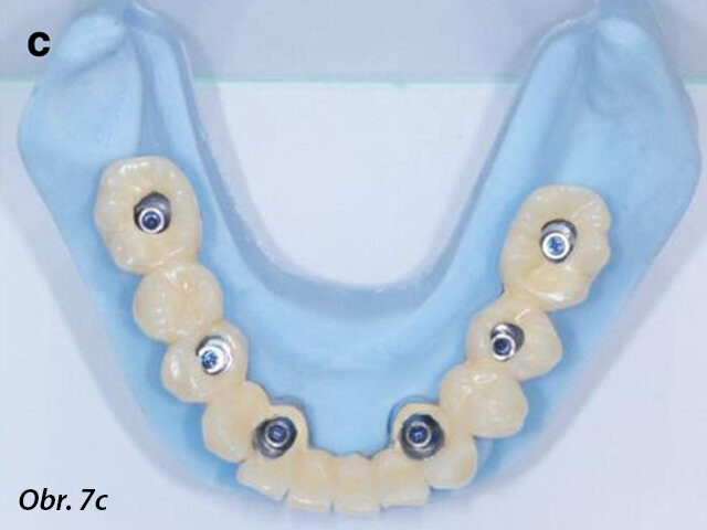 CAD/CAM model s prefabrikovanými titanovými abutmenty (a), CAD/CAM chromkobaltová základní konstrukce (b) a provizorní fixní náhrada fazetovaná kompozitem (c, d) před připevněním na abutmenty.