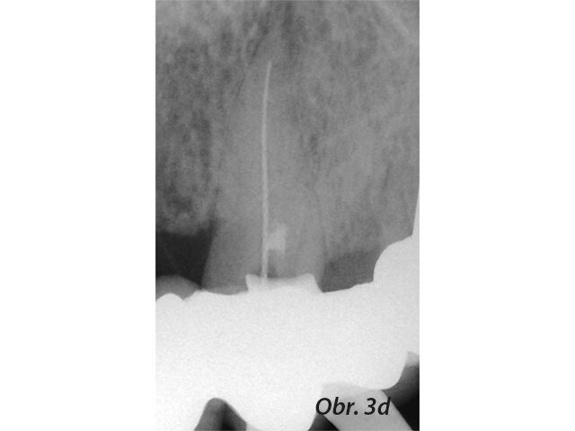Původní stav se zaplněnou perforací
