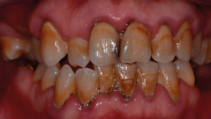 Carie e brown spot: il recupero dell’estetica del sorriso tra debridment, sbiancamento, infiltrazioni, ricostruzioni. Case report