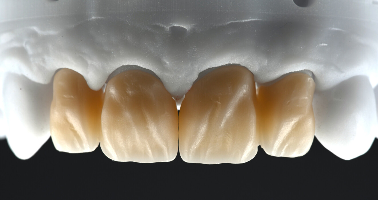 Fig. 3 : Restaurations sur le modèle après caractérisation avec des colorants liquides et frittage.