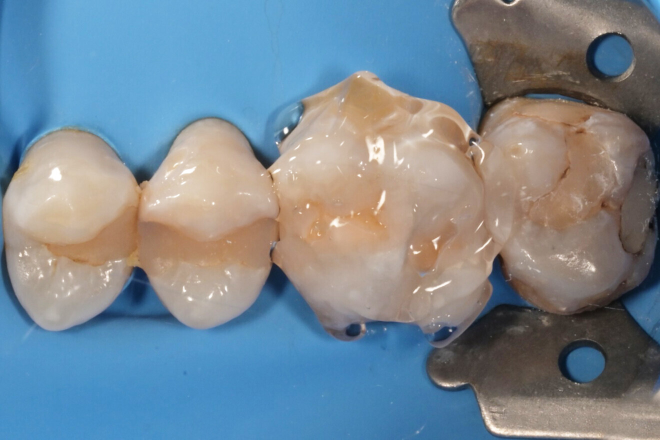 Фиг. 11: Полимеризиране на композита през глицеринов гел.