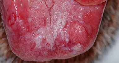 Oral cancer patient sues dentist