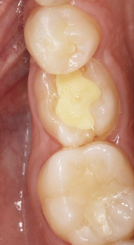 Fig. 3_Visualizzazione occlusale dx.