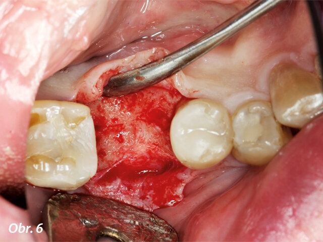 Odklopený mukoperiostální lalok, okluzní pohled.