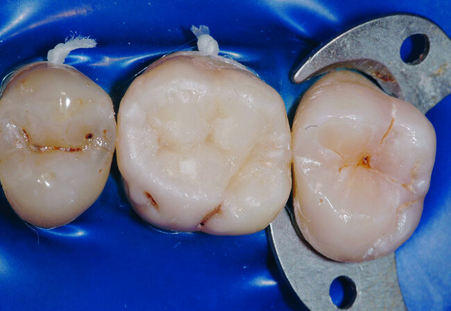 Fig. 27: Vue occlusale après apport d’un dernier apport de composite de masse email en superficie. 