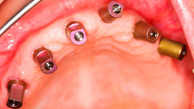 Nuova nanotecnologia per migliorare il ripristino osseo in pazienti dentali