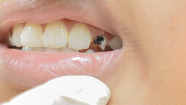 Zaawansowana próchnica i leczenie odtwórcze – aktualne rekomendacje