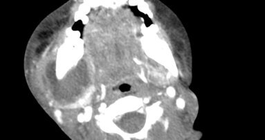 Linfoadenopatia ascessualizzata di origine odontogena: case report