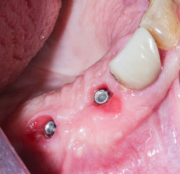 Fig.14: The osteosynthesis screws were not removed because they were not visible under the gingiva.